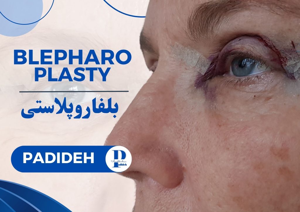 بلفاروپلاستی (Blepharoplasty)