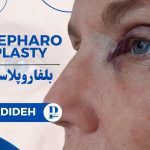 بلفاروپلاستی (Blepharoplasty)