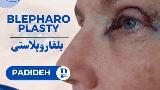 بلفاروپلاستی (Blepharoplasty)